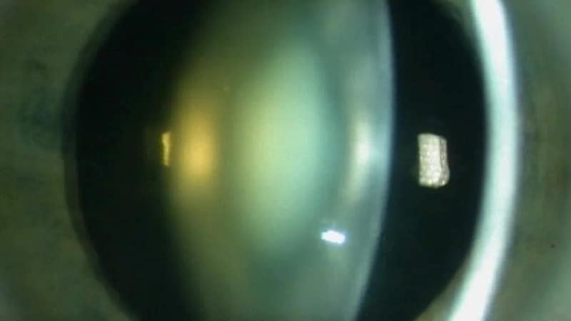 Photo en gros plan d’un cristallin opacifié illustrant une cataracte nucléaire