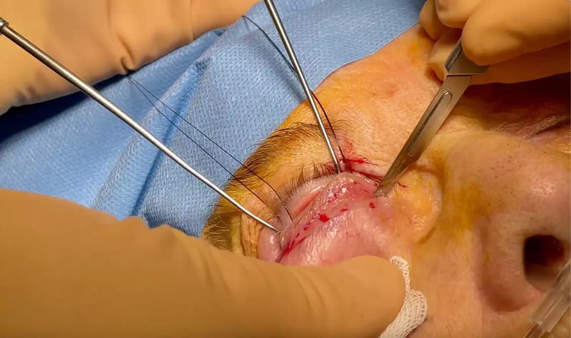 Blépharoplastie inférieure par voie cutanée : vue peropératoire avec incision sous-ciliaire (sous les cils) et geste de correction des poches sous les yeux.