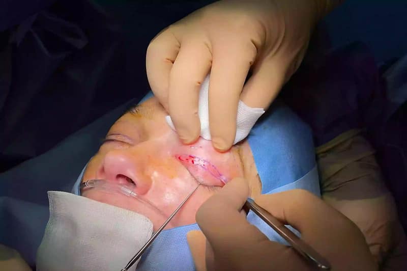 Chirurgie esthétique des paupières : geste précis pour corriger l’excès de peau et rajeunir le regard.