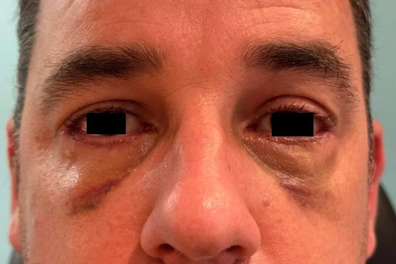 Visage de face illustrant une blépharoplastie inférieure : traitement des poches sous les yeux avec incision sous-ciliaire (yeux anonymisés).