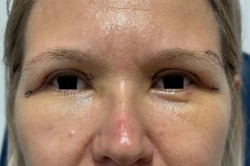 Visage de face illustrant une blépharoplastie supérieure : correction de l’excès de peau de la paupière supérieure (yeux anonymisés).