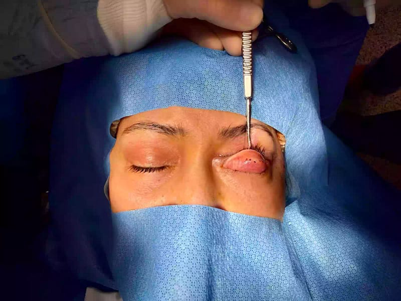 Chirurgie du ptosis par voie conjonctivale (résection conjonctivo-müllérienne) : vue per-opératoire de la paupière supérieure avec instruments chirurgicaux.
