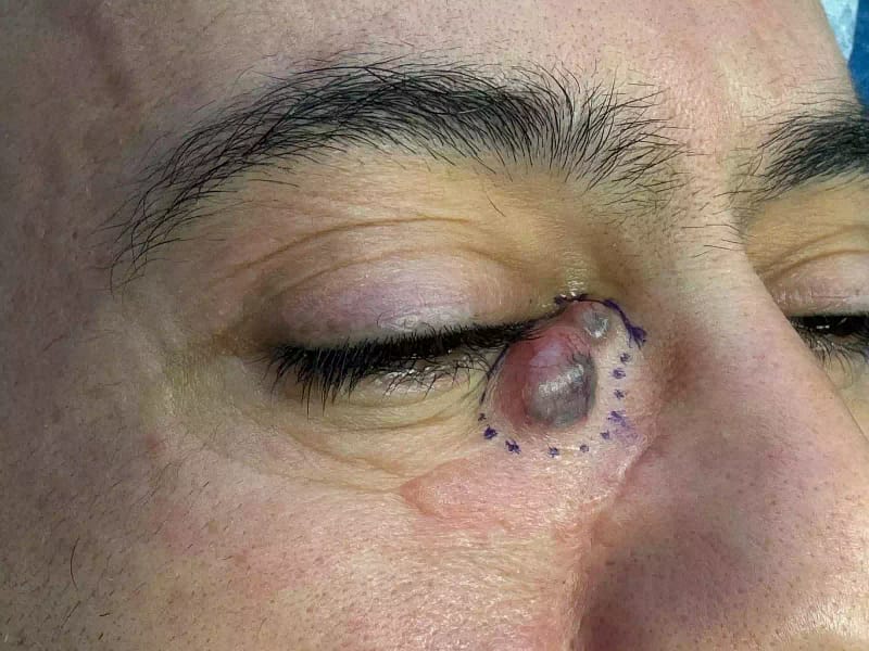 Gros plan d’une paupière avec une lésion palpébrale et un marquage préopératoire en vue d’une exérèse chirurgicale.