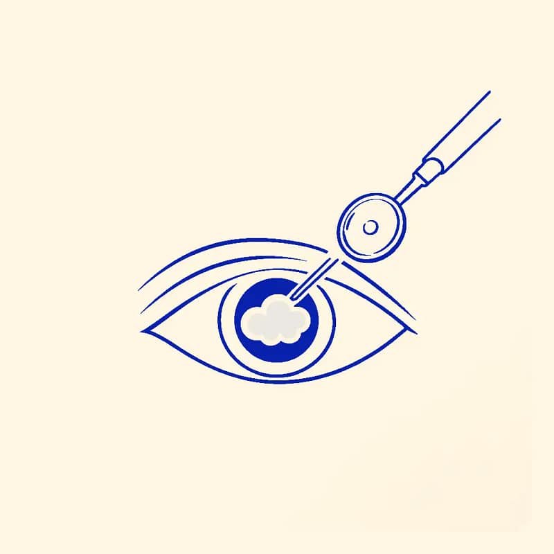 Icône d’un œil avec une cataracte et un instrument chirurgical représentant l’opération de la cataracte